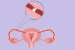 tomber enceinte avec les deux trompes bouchées