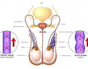 Traitement naturel contre la varicocèle